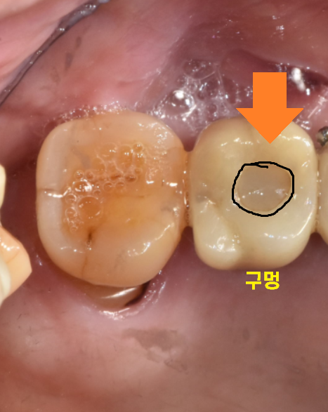 명일동 치과 임플란트 주의사항 끝날 때까지 끝난게 아니다 관련 이미지 4