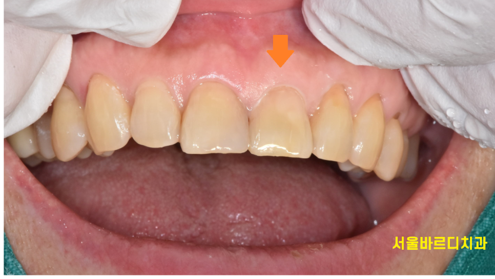 앞니 레진 재치료 변색 부위 연마하면 처음 느낌 그대로 관련 이미지 6