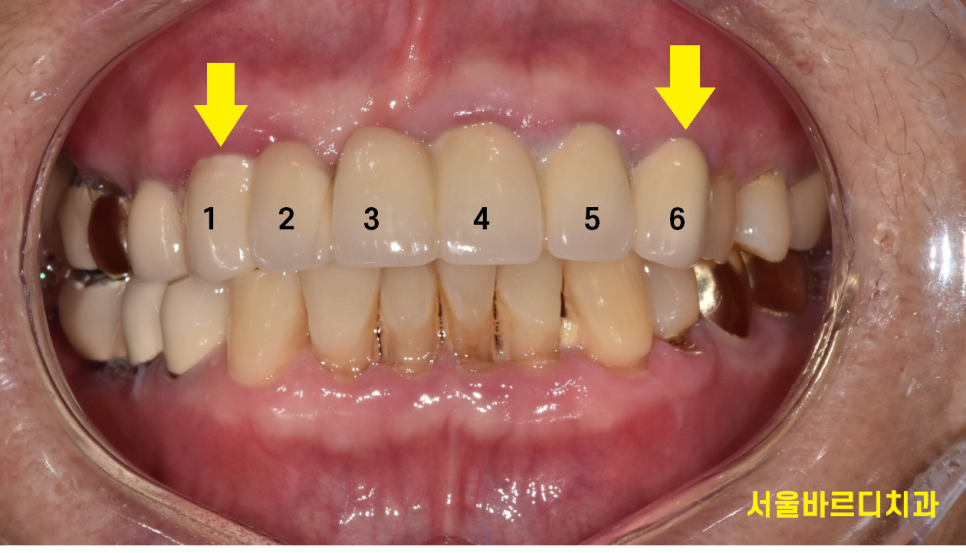 상일동 치과 충치로 인한 앞니 브릿지 파절 재건해보았습니다. 관련 이미지 2