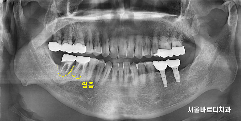 치아뿌리 염증 통증 유무 상관없이 치료를 받아야하는 이유 관련 이미지 2