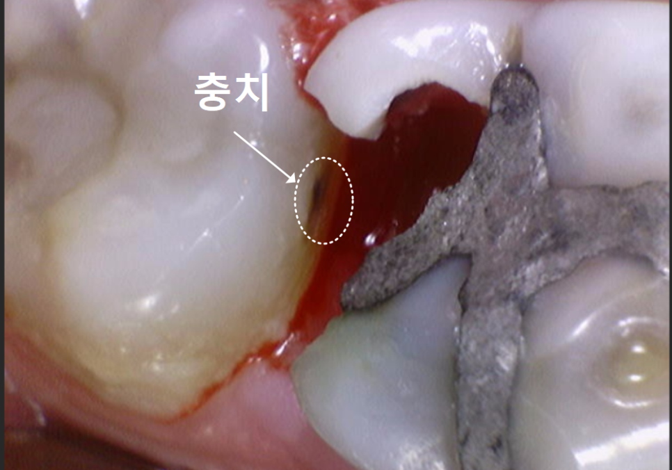 고덕동 어금니 사이 충치, 양치질 누구보다 열심히 하는데 왜 자꾸 생길까요? 관련 이미지 12