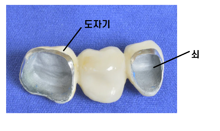 앞니 잇몸 검은색 라인 오래된 pfm 보철 교체하세요!! 관련 이미지 4
