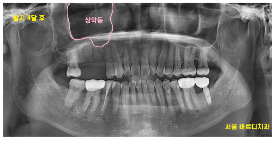 고덕역 임플란트 잇몸 뾰루지 뼈이식 두번 하여 해결했습니다. 관련 이미지 8