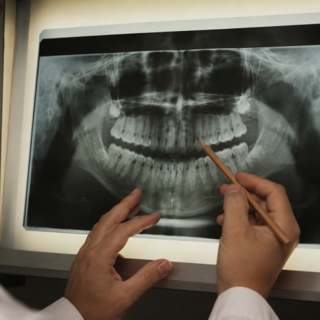 Dental Implants Without Cutting the Gums? When Flapless Implant Placement Is Possible image 3