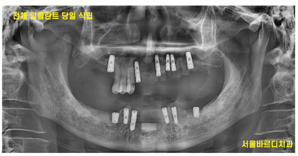 상일동 임플란트 잘하는곳 치료는 이렇게 진행됩니다. 관련 이미지 7
