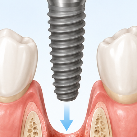 Dental Implants in Just One Day? Is a One-Day Implant Possible for Everyone? image 2