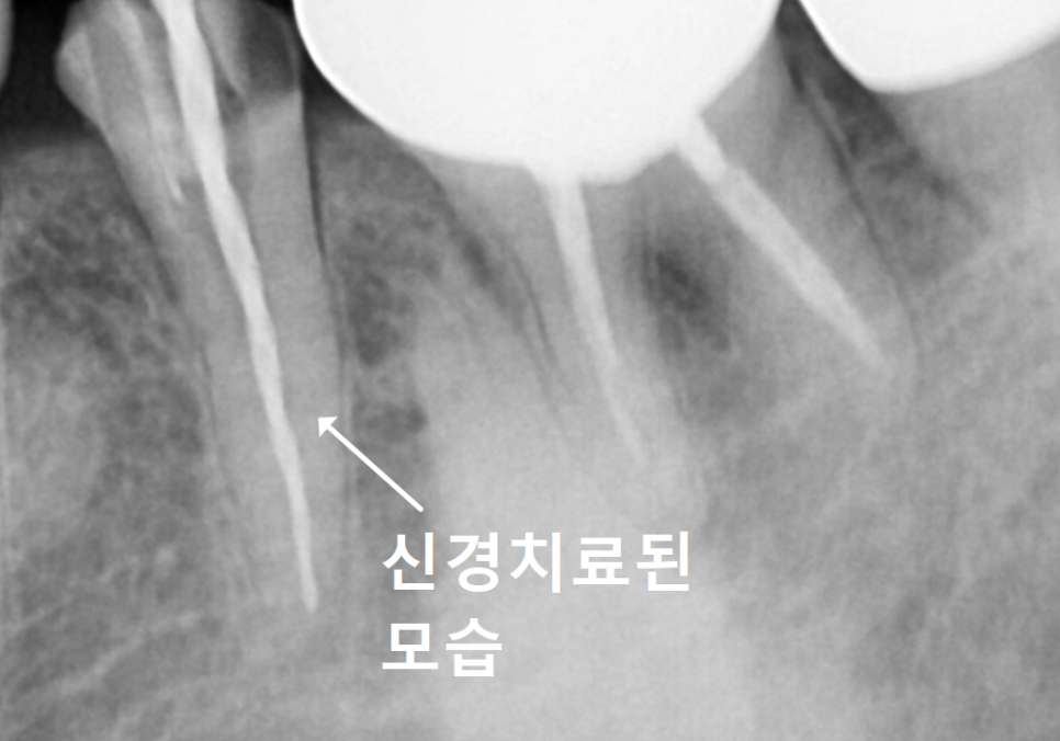아말감 파절, 조금 깨졌을 뿐인데, 2차 충치로 치아 절반이 깨진 사연 관련 이미지 7