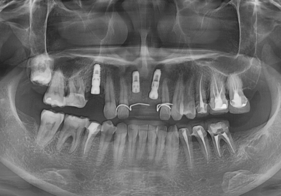 잇몸 까매짐 원인,증상,치료 방법 오래전에 앞니 씌운 곳 잇몸이 까매졌어요. 관련 이미지 11