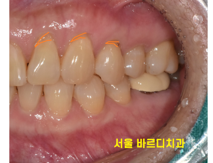 강동구 스케일링 치아 삭제 한다고 오해하지 마세요! 관련 이미지 4