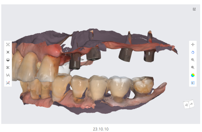 미사 임플란트 70대 연령과 상관없는 치료 과정 관련 이미지 8