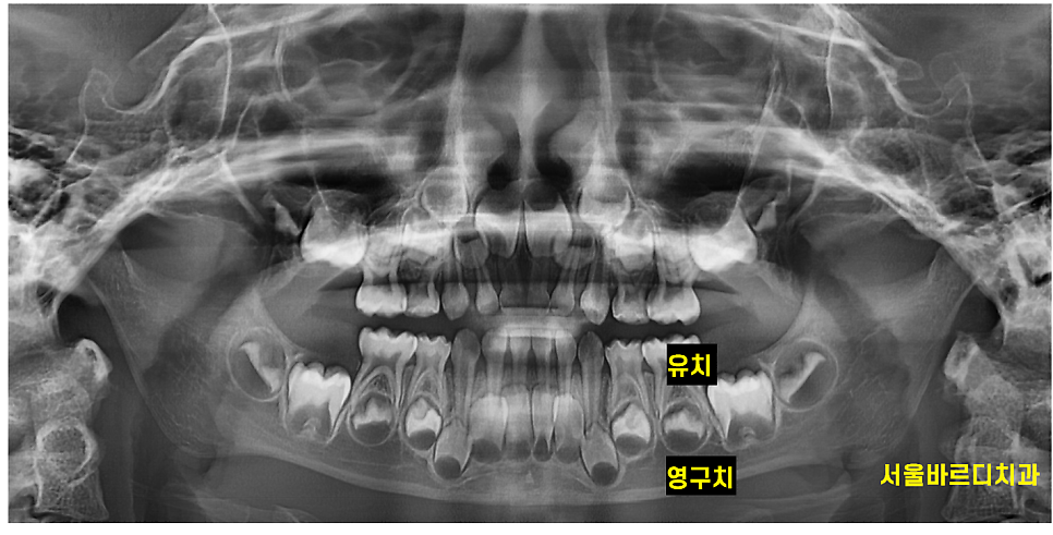 상일동 어린이치과 유치 곧 뽑을 치아이지만 치료가 필요한 이유 관련 이미지 5