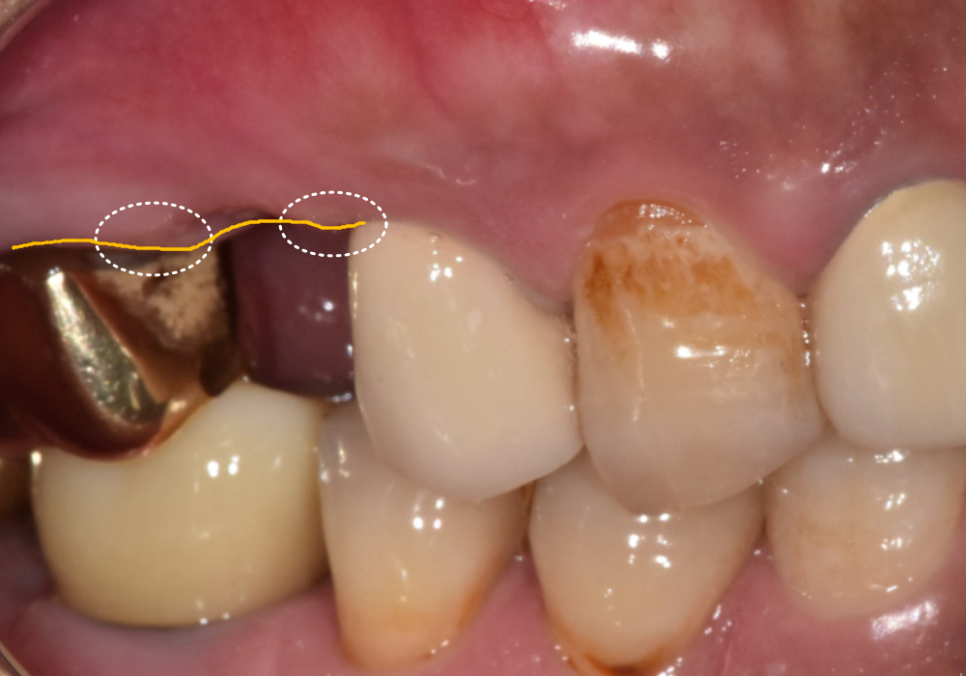 상일역 임플란트, 음식물 끼는 이유, 처음엔 안 그랬는데 왜 점점 심해지는 걸까요? 관련 이미지 4