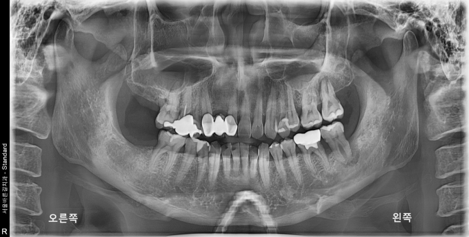 상일동치과 서울바르디치과 무절개 네비게이션 임플란트 치료증례 #7 관련 이미지 1