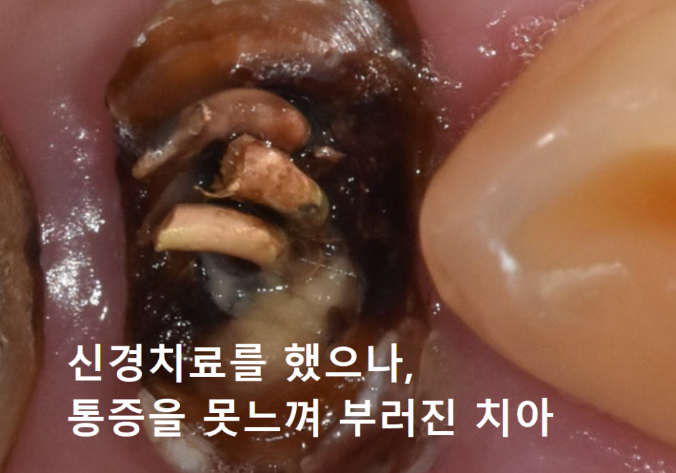 강동구 오래된 보철, 교체 시기는? 아프지 않은데 꼭 바꿔야 하나요? 관련 이미지 3