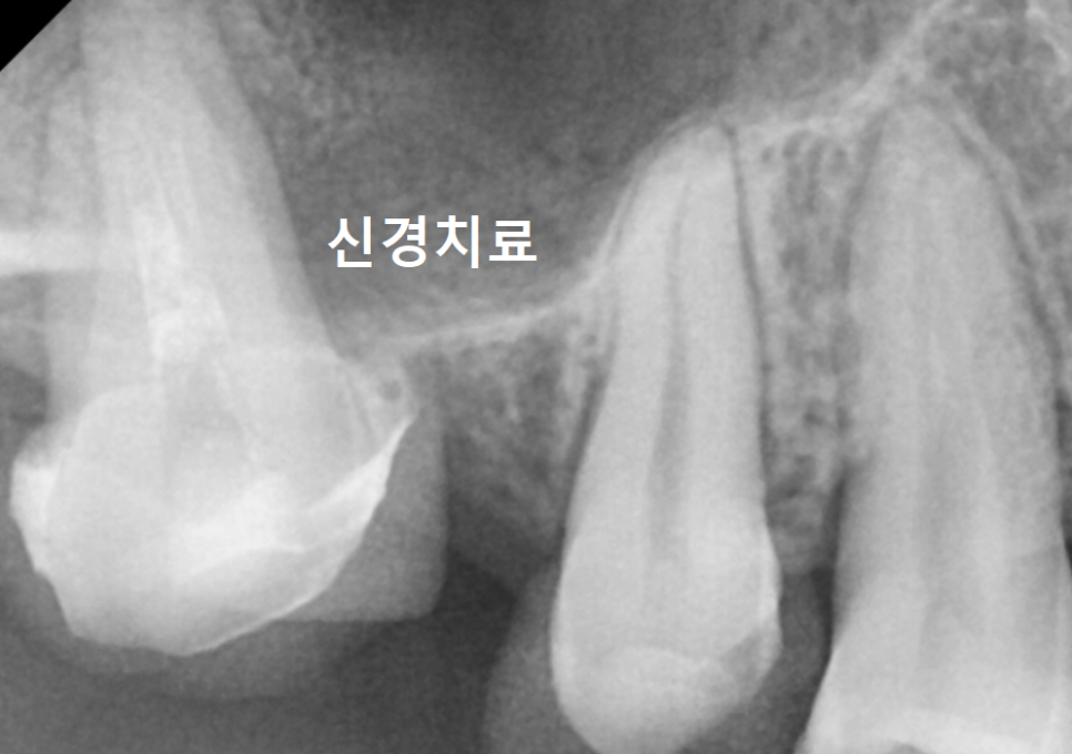 Myeongil-dong Implant Treatment in Your 20s: The Reason It Ended Up Requiring Bone Grafting After Thinking, “I’m Young, So It’ll Be Fine” image 7