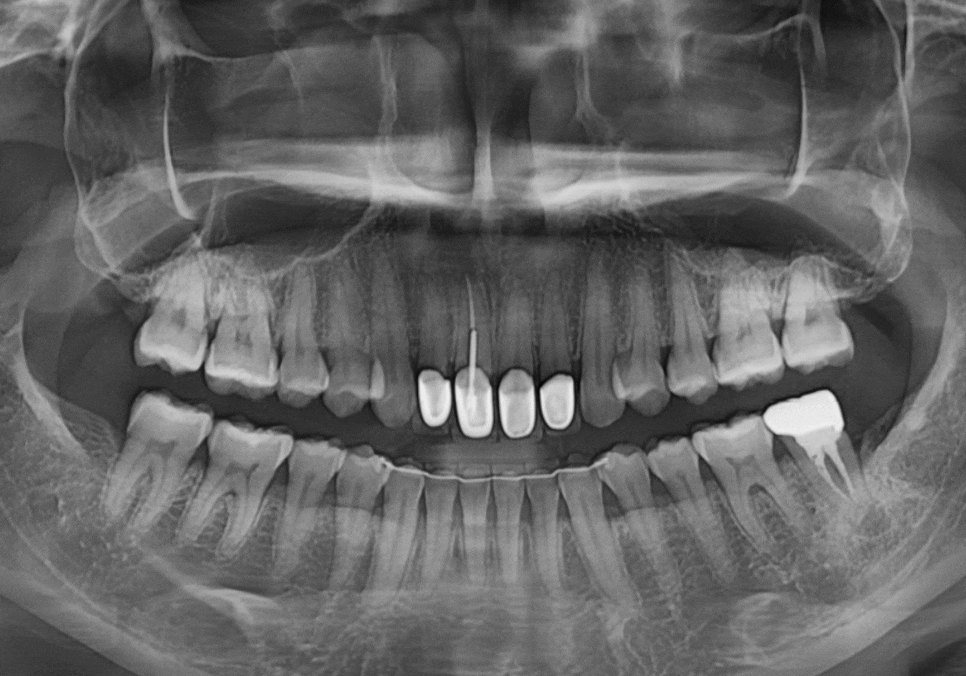 강동구 치아 뿌리 염증, 신경치료 한 치아인데도 아플 수 있나요? 관련 이미지 13