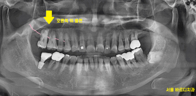 강일동 치과추천 어금니 시림 방치하지마세요 발치하고 임플란트 할 수 있습니다. 관련 이미지 1