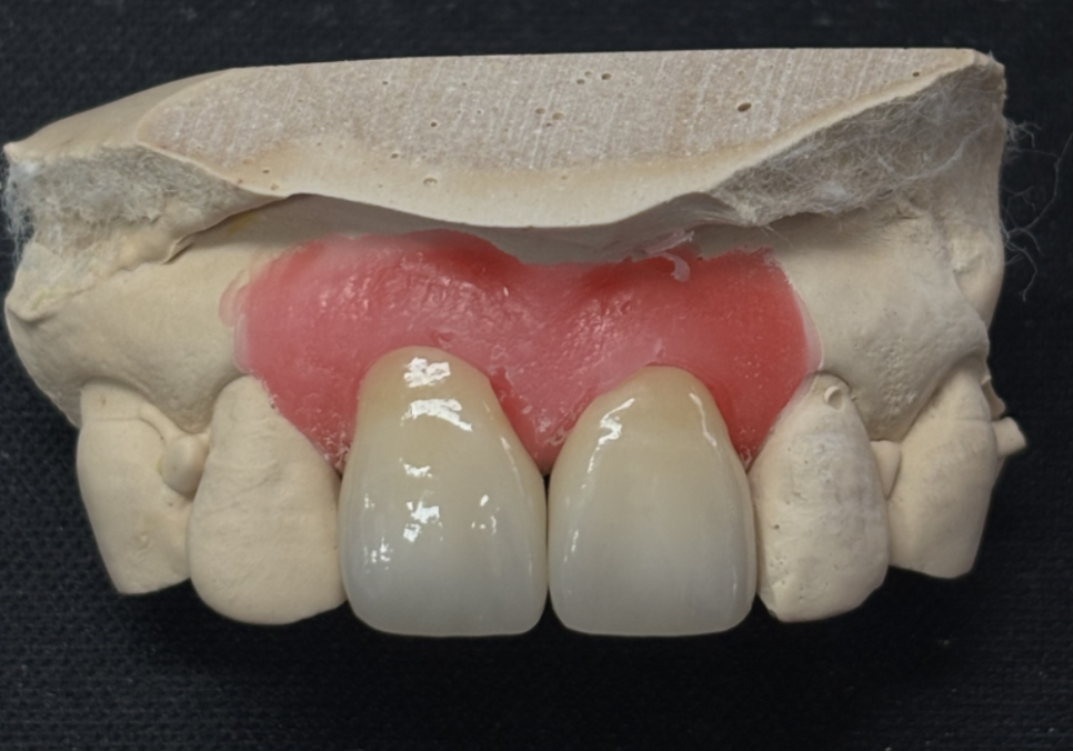 대문니 파절, 앞니에 금이 쩍 갈라졌다면? 딱딱한 음식을 조심해야 하는 이유 관련 이미지 13
