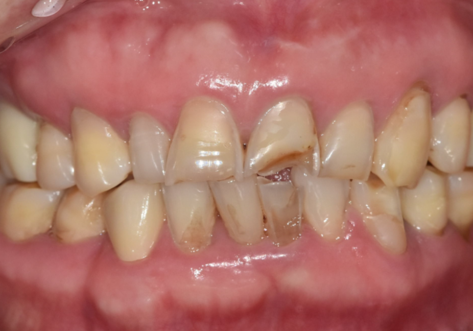 대문니 파절, 앞니에 금이 쩍 갈라졌다면? 딱딱한 음식을 조심해야 하는 이유 관련 이미지 2