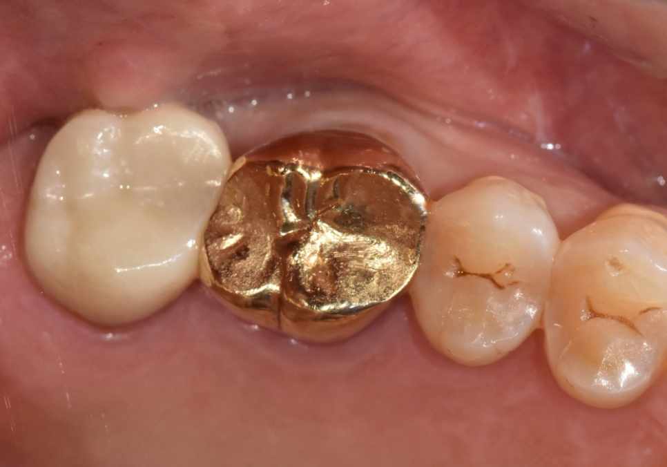시큰거리는 통증, 시린 이 치약으로 해결 안 된다고요? 관련 이미지 11