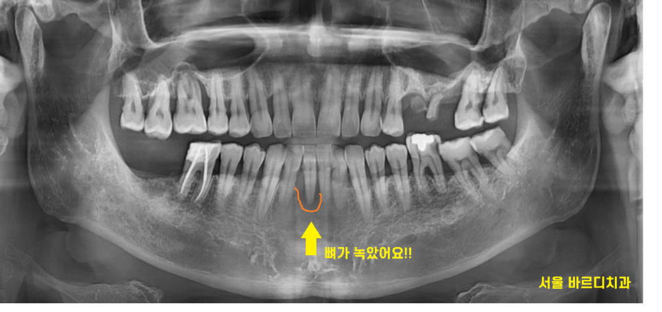 둔촌동 치과 아래 앞니 임플란트 뼈가 없을 때 일체형으로! 관련 이미지 2