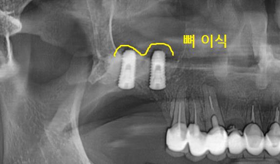 명일동 치과 뿌리 염증으로 입냄새가 나요 해결책은? 관련 이미지 8