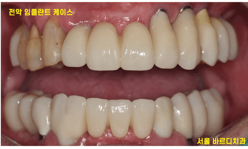 상일동 임플란트 잘하는곳 치료는 이렇게 진행됩니다. 관련 이미지 1