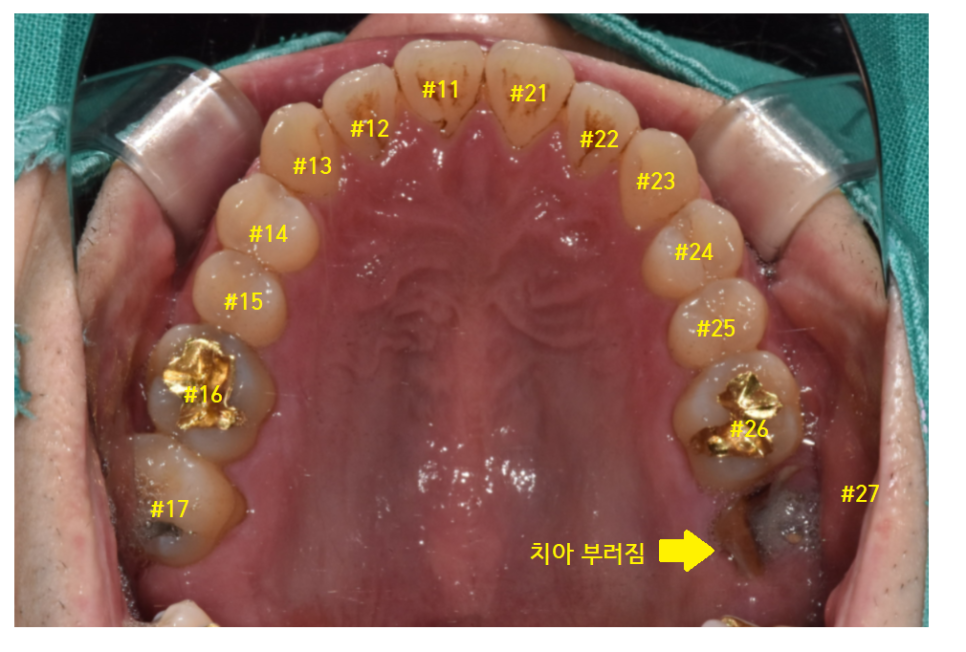 암사동 치과 임플란트 꼭 안 해도 되는 경우 궁금증 해결해 드려요 관련 이미지 7