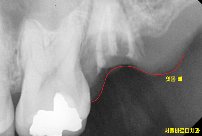 감일동 치과 첫번째 임플란트 시작이 중요합니다. 관련 이미지 4