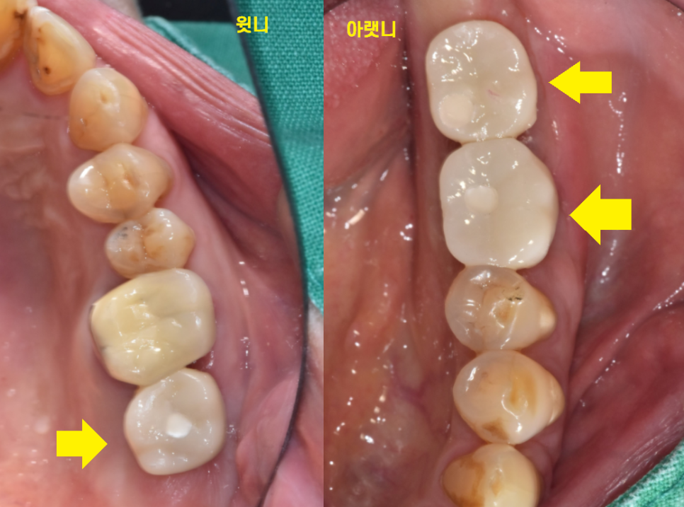고덕동 치과 어금니 흔들림과 통증 임플란트가 답일 때! 관련 이미지 9