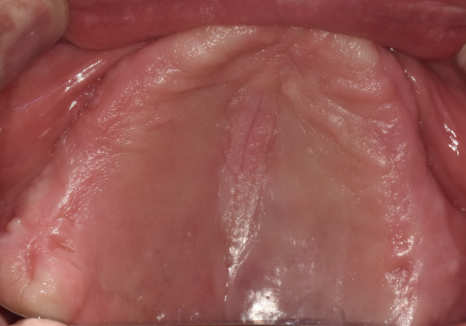 뼈가 없어서 안 된다구요? 70대 당뇨 무치악 환자분의 전체 임플란트 사례 관련 이미지 1