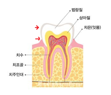 입 마름 치근 우식증이 쉽게 생길 수 있습니다!! 관련 이미지 6