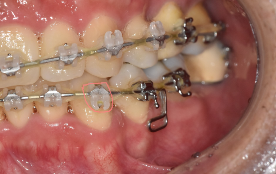 교정 중 충치 치료 먼저? 계속 방치? 알려드립니다. 관련 이미지 3