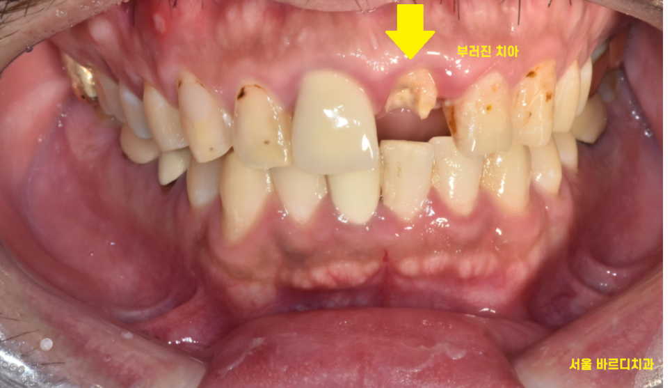 앞니 부러짐 손상이 커서 하남선동치과에서 임플란트 치료 관련 이미지 2