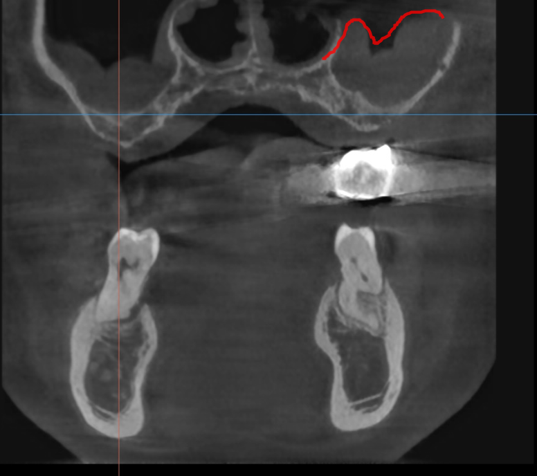 임플란트 시술 성공률, 얼마나 높을까? 처음 하시는 분들께 관련 이미지 4