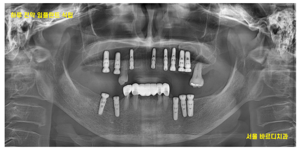 강동구 임플란트 어금니 상실 방치하다 치매까지 옵니다. 관련 이미지 9