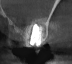 상일동 임플란트 상악동 거상술을 동반한 수술 증례 관련 이미지 7