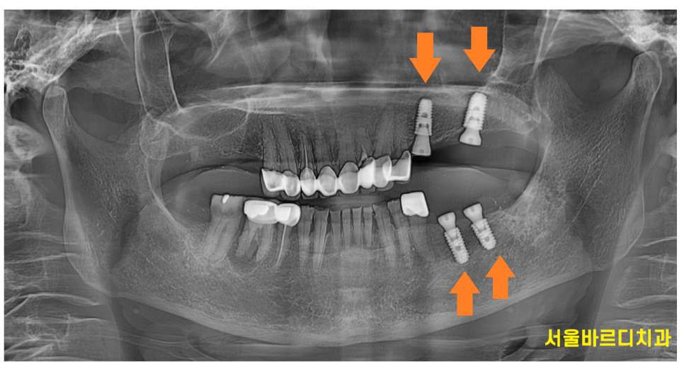 하남 임플란트 치과 주문진에서부터 치료 받으러 오신 환자분 관련 이미지 6
