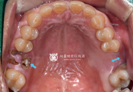 고덕동치과 서울바르디치과 무절개 네비게이션 임플란트 치료증례 #1 관련 이미지 5