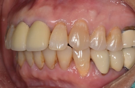 Godok Implant: Treatment That Reduced the Financial Burden with Insurance Implants for a Patient in Their 70s image 2