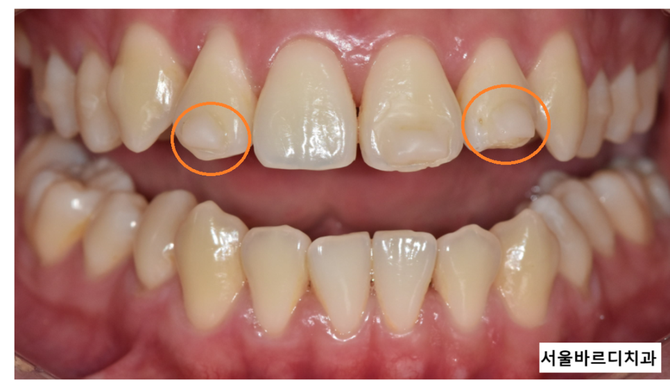 명일동 치아 교정 타이밍 언제 시작하는게 좋을까? 관련 이미지 4
