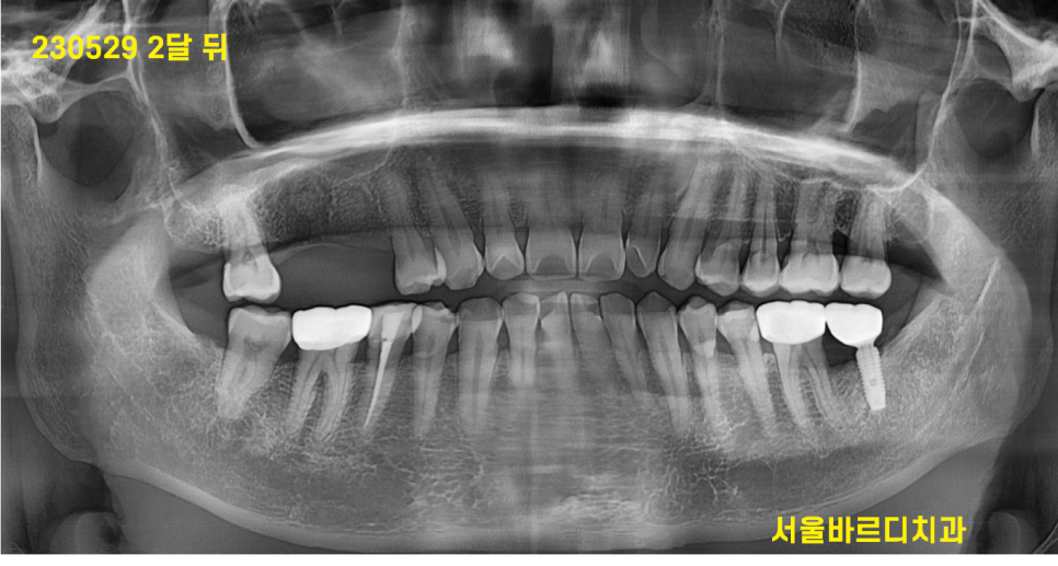 고덕동 치과 잇몸 주저앉음 느낌이 들었다면 늦었을 수도 있습니다. 관련 이미지 7
