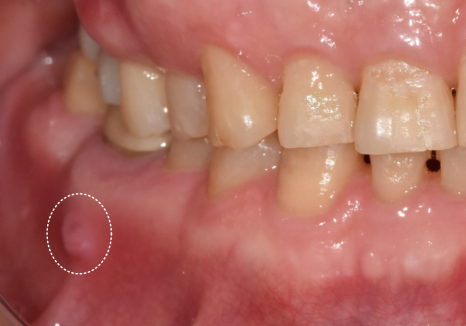 강동구 잇몸 여드름, 이런 상태라면 절대 겉에만 짜는 치료 하지 마세요. 관련 이미지 3