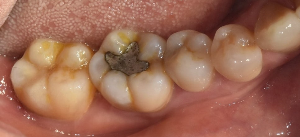 Gangdong-gu Dental Clinic: I Gag So Easily That I’m Too Afraid to Go to the Dentist. Tips to Reduce Gagging image 1