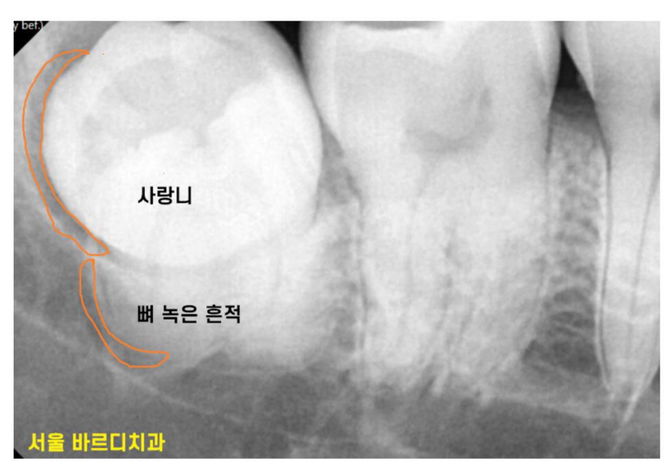맨 끝 어금니 임플란트 먼저 무너지는 이유가 있습니다. 관련 이미지 4