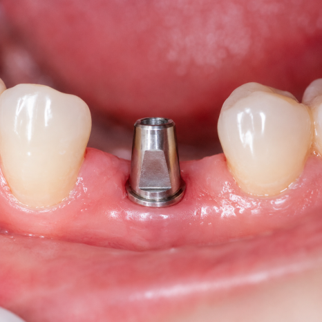 Dental Implants image 2