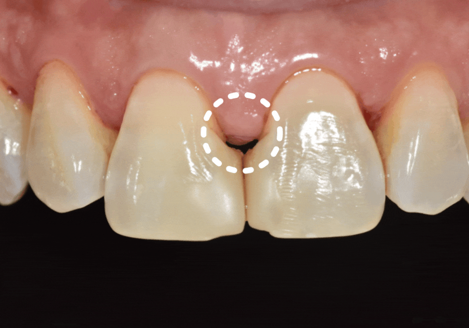 고덕동 치과 누런 이, 앞니 사이 틈, 잘못된 관리 때문일까? 관련 이미지 8