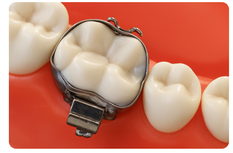 Orthodontic Bracket Debonding: Please Pay Attention If You Have Many Prosthetic Restorations image 6