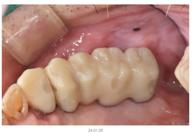 미사 임플란트 70대 연령과 상관없는 치료 과정 관련 이미지 10