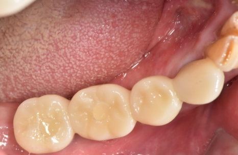 오래된 어금니 롱브릿지, 교체 타이밍을 놓치면 관련 이미지 16